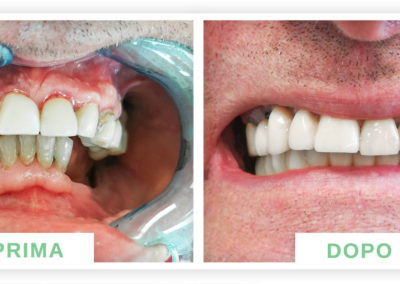 denti prima e dopo