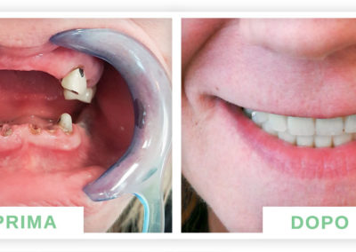 denti prima e dopo
