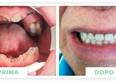 denti prima e dopo