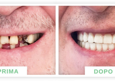 denti prima e dopo