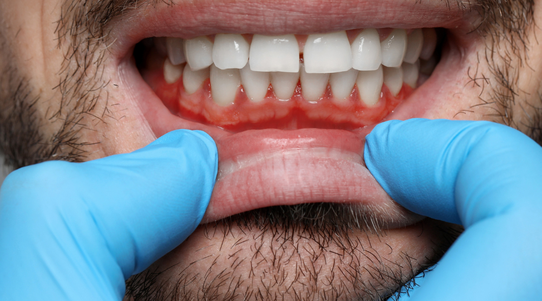 Gengive: 5 domande da farti per capire se sono in salute